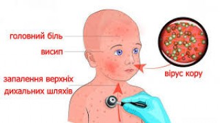 Кір - небезпечне інфекційне захворювання